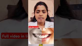 How aligner works  எப்படி aligner work ஆகுது tooth dentist aligner dentalclinic dentalbraces [upl. by Grefer76]