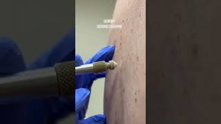 shorts How Dermatologists Remove Skin Growths with Liquid Nitrogen [upl. by Eneluj]