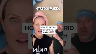 HOW TO GET RID OF STRETCH MARKS  THIS WORKS [upl. by Auos]