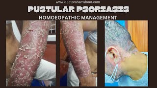 PUSTULAR PSORIASIS [upl. by Mick167]