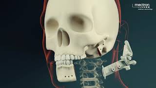 PIEZOSURGERY®  Mandibular Reconstruction Animation [upl. by Ner4]