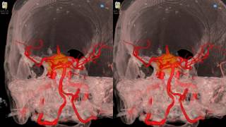 Cavernous Meningioma  3D Virtual Tour  UCLA Neurosurgery [upl. by Nagiem13]