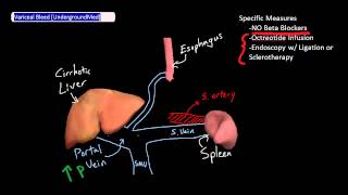 Variceal Bleed Management UndergroundMed [upl. by Annaya]