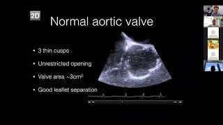 Aortic Stenosis [upl. by Nayllij]