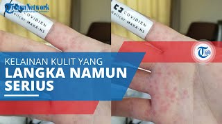 Stevens–Johnson Syndrome Kelainan Kulit yang Langka Namun Serius dan Bisa Menyebabkan Kematian [upl. by Cranston]