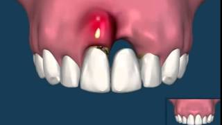 The Difference Between A Dental Bridge and Dental Implants [upl. by Edveh]