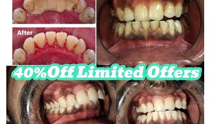 Scaling and Polishing Price in PakistanTooth whitening costBleaching procedureScalingProcedure [upl. by Chrissie]