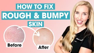 How To Fix Rough and Bumpy Skin  Keratosis Pilaris Affordable Skincare Routine [upl. by Nahtnamas]