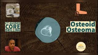 Osteoid Osteoma  Everything You Need To Know  Dr A B Govindaraj mgmhelathcare [upl. by Otrebron]