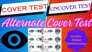 CoverUncover testsKanskis clinical ophthalmology squint tropia phoria [upl. by Xonel]