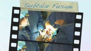 Subtalar Arthrodesis Surgical Technique Joint Exposure using the Tarsal Joint Distractor [upl. by Gerrald]