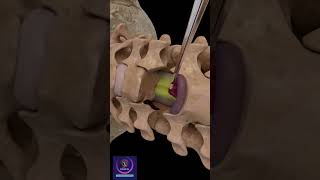 Anterior Cervical Discectomy amp Fusion shorts [upl. by Delos]