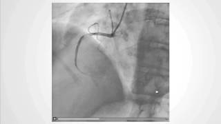 Decoding the NoReflow Phenomenon Coronary Microcirculations Role [upl. by Sapphire133]