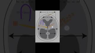 How to diagnose hydrocephalus on CTMRI [upl. by Hacker]