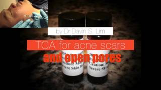 TCA CROSS for enlarged pores and ice pick acne scars [upl. by Baggett]