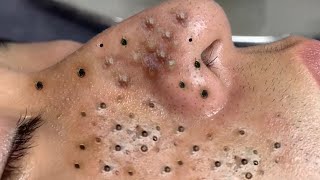 Blackheads amp Acne Treatment Latest Update 64 [upl. by Airemaj]