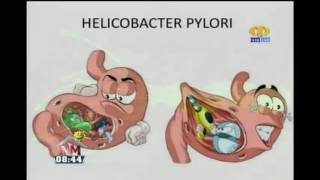 Helicobacter pylori Sintomas y tratamiento [upl. by Ulberto42]