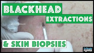 Blackhead extractions amp 2 Skin Biopsies [upl. by Yecac]