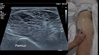 Hamstring Ultrasound 101 [upl. by Annelg]