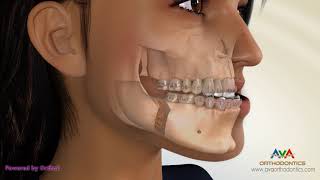 Surgical Orthodontic Treatment for Underbite or Crossbite  Transcortical Mandibular Setback [upl. by Risa638]