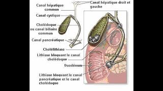 Calculs biliaires faites les fondre facilement [upl. by Kevan43]