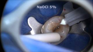 Endodontic Access and Root Canal Preparation explained [upl. by Zeuqirdor]