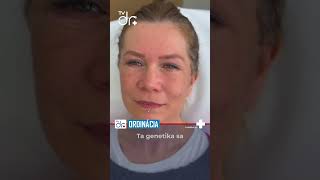 MUDr T Ventrubua PhD povie o technikách omladenia a jeho obľúbenom facelifte facelift vlift [upl. by Other]