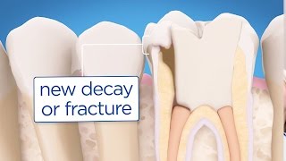 Root Canal Retreatment Explained [upl. by Hamian799]