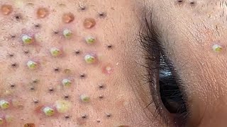 Relax Every Day With Loan Nguyen Spa  Acne Treatment Pimple Popping 44 [upl. by Diogenes]