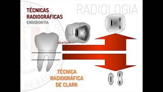 Radiologia em Endodontia  Técnica de Clark [upl. by Anitac]