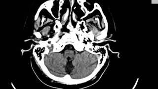 CASE 348 CT BRAIN LACUNAR AND BASAL GANGLIA INFARCTION ATROPHIC CHANGES [upl. by Elac381]