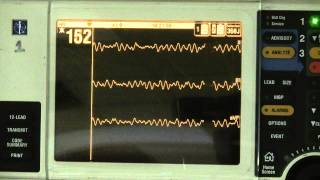 Ventricular Fibrillation [upl. by Willard827]