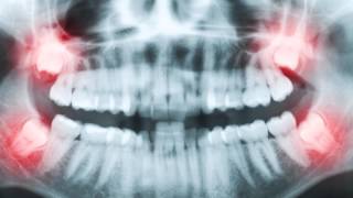 Impacted Teeth  Abnormalities in Tooth Quantity 2 [upl. by Robers383]