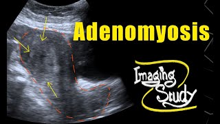 Adenomyosis  Ultrasound  Case 69 [upl. by Airak415]