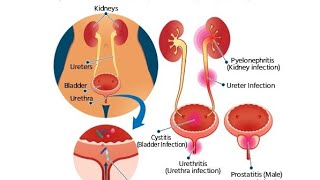 INFEKSIONET URINARE ESCHERICHIA COLIinfeksioneturinare escherihiacoli traktiurinarinfeksionet [upl. by Oleusnoc]