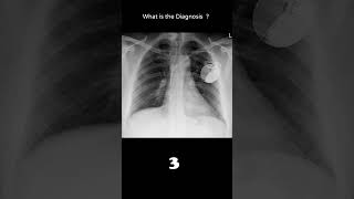 Implantable cardioverter defibrillator 164 Cardiac disease chest xray Quiz radiologychannel007 [upl. by Nwahsear76]