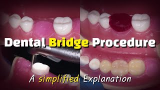 Dental Bridge Procedure [upl. by Ciri338]