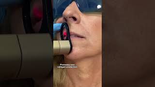 Lip Rejuvenation amp Brightening with CO2 LASER  DR MEDISPA [upl. by Edholm]