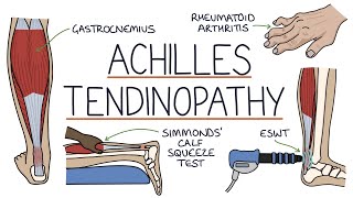 Understanding Achilles Tendinopathy Achilles Tendinitis [upl. by Nabe588]