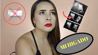 Mi historia con el ACNE me enferme del hígado Karomakeup [upl. by Thomajan]