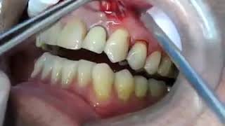 Popping a Dental Abscess [upl. by Anirret]