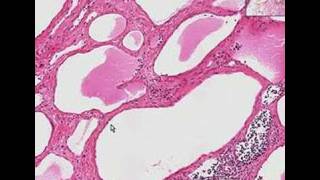 Histopathology NeckLymphangioma cystic hygroma [upl. by Accalia]