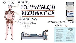 Polymyalgia Rheumatica Visual Explanation for Students [upl. by Aunson]