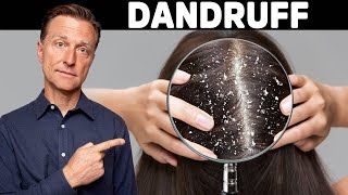 The REAL Cause and Cure for DANDRUFF [upl. by Letch656]