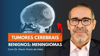 Tumores cerebrais benignos Meningiomas [upl. by Seafowl]