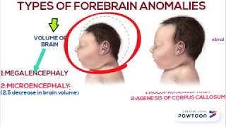 Forebrain anomalies part 1 [upl. by Selia309]