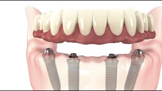 What is an Allon4 Dr Michael Le  Elite Dentistry [upl. by Yecaw287]