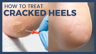 How To Treat Cracked Heels  Reduce Callus and Fissures [upl. by Earahc778]