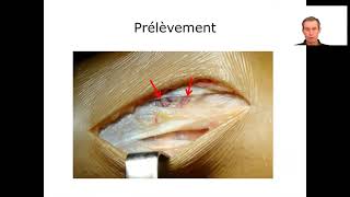 Reconstruction du Ligament Croisé Antérieur LCA Technique utilisant le Fascia Lata [upl. by Niltiak]