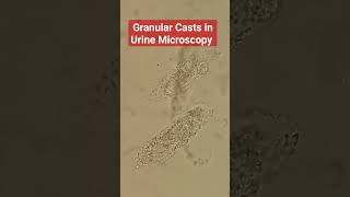 Granular Casts in Urine Microscopy [upl. by Edan]